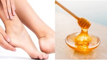 How To Use Honey For Cracked Heels | Benefits, Causes, Uses