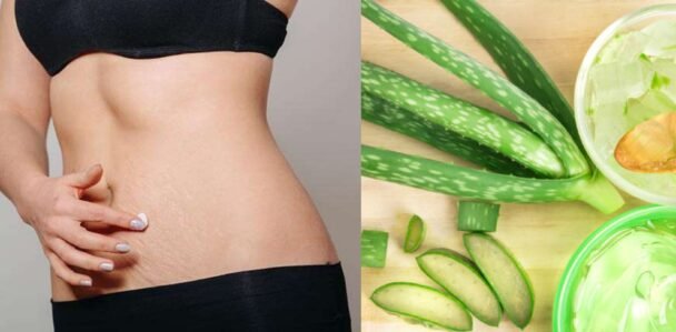Is Aloe Vera Good For Stretch Marks?